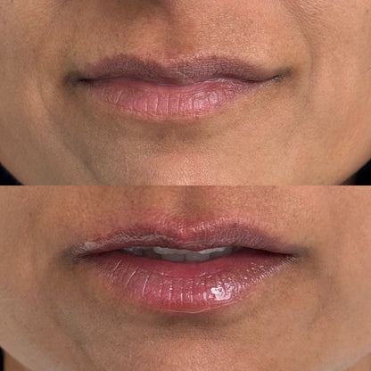 Plump It! No Needles Lip Filler Kit