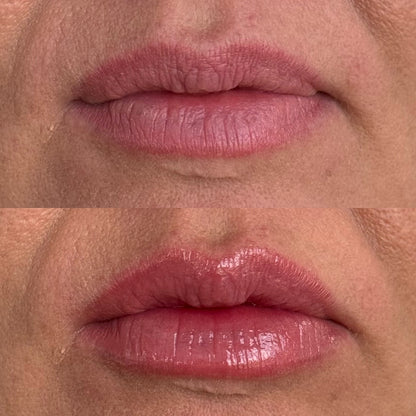 Plump It! No Needles Lip Filler Kit