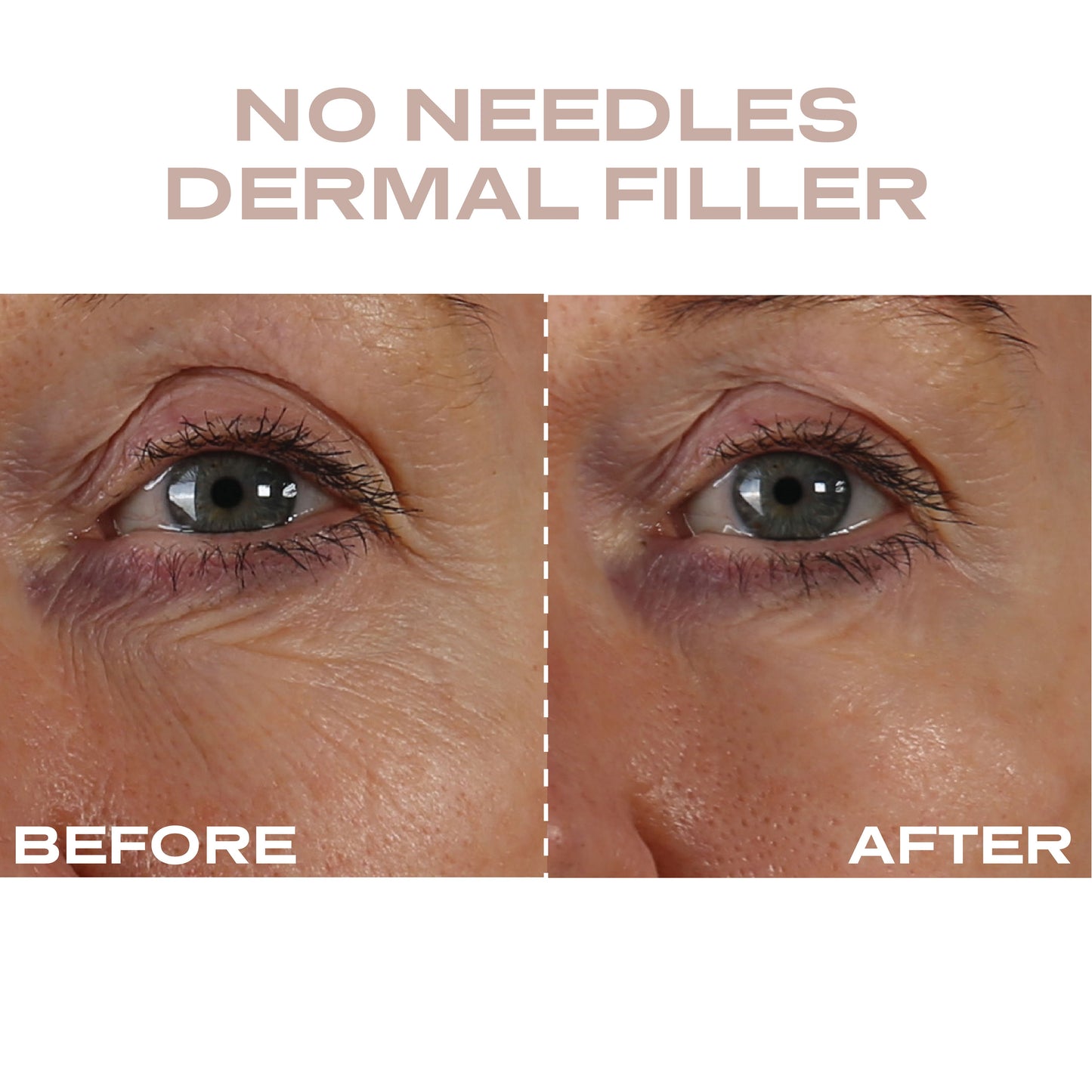 Plump It! No Needles Dermal Filler
